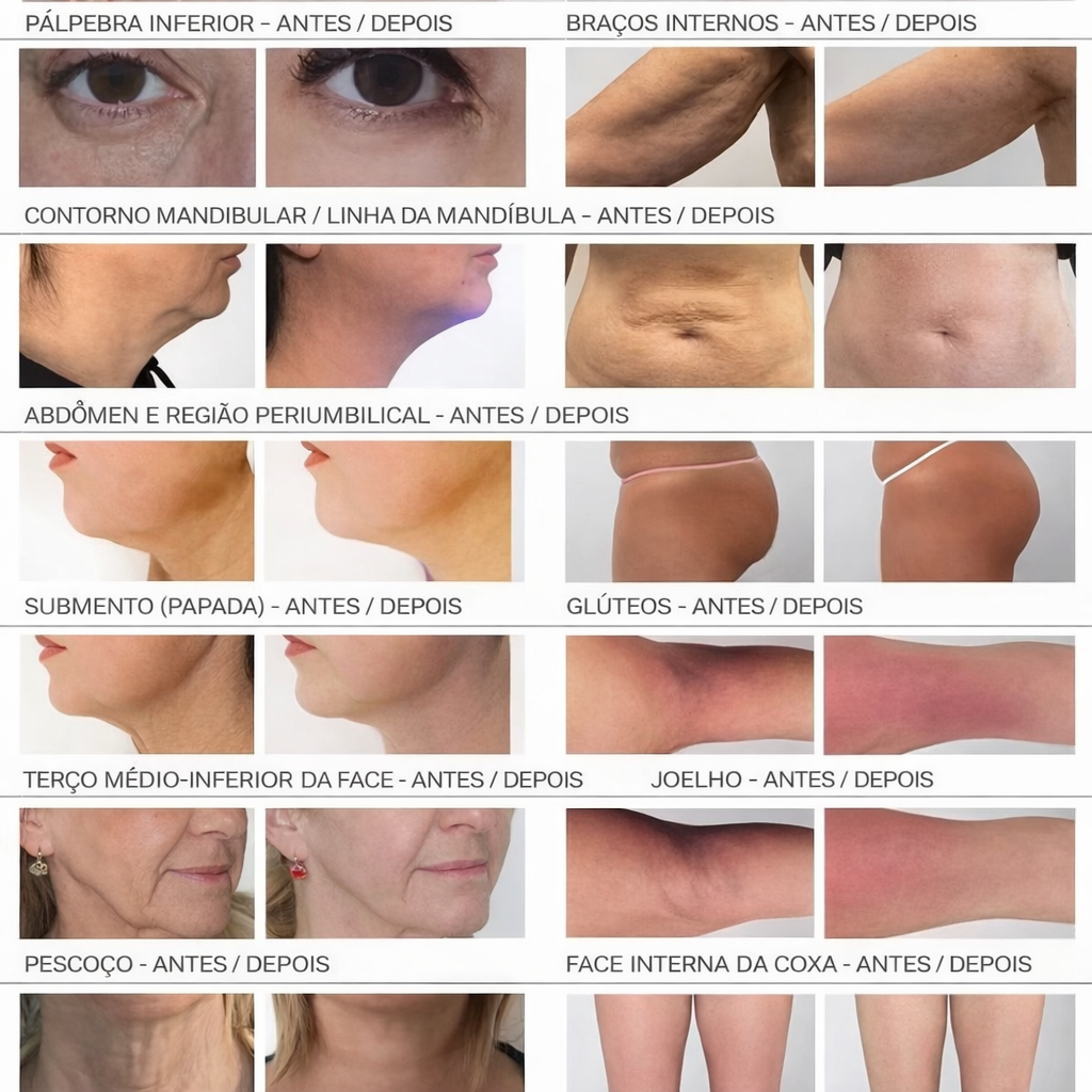 Endolaser TripleWavePRO 980nm+1470nm+635nm Ponteira Vascular - Última geração 2026